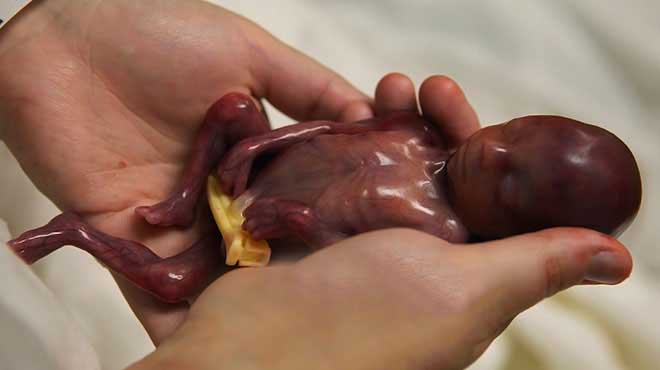 O bebê que está mudando o debate sobre o aborto